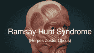 Ramsay Hunt Syndrome