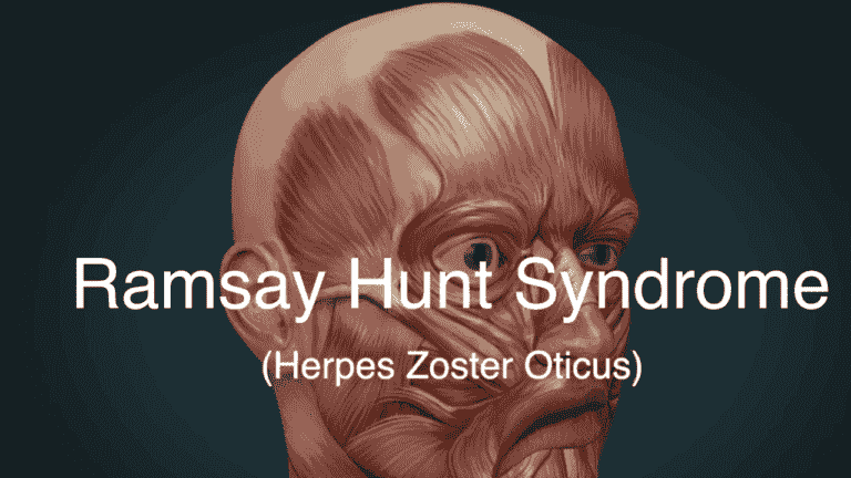 Ramsay Hunt Syndrome